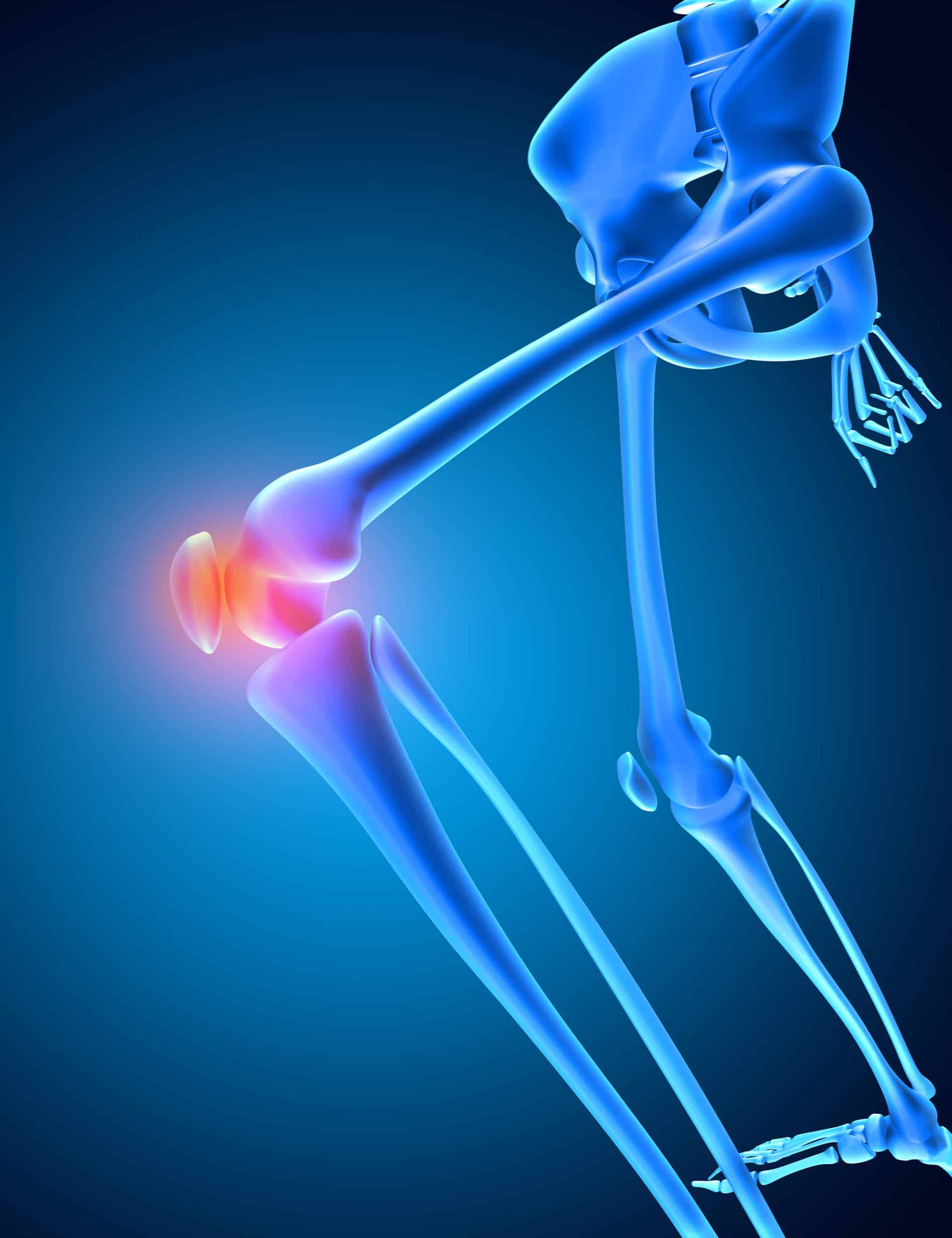 sport garantie de santé: arthrose